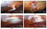 Unbilical Hernia Surgery Pictures_01.jpg